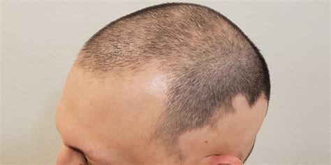 scalp micropigmentation sa|Scalp Micro Pigmentation in Riyadh & Saudi Arabia .